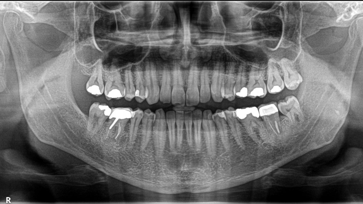دندانپزشکی: دندان عقل
