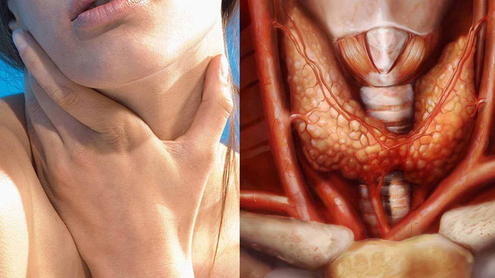 بزرگی غده تیروئید و اختلال بلع (دیسفاژی)