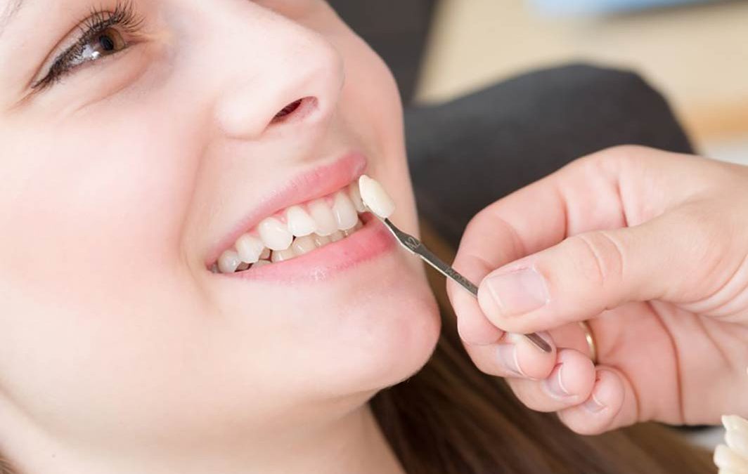 روکش دندان و دلایل نیاز به آنها – قسمت اول