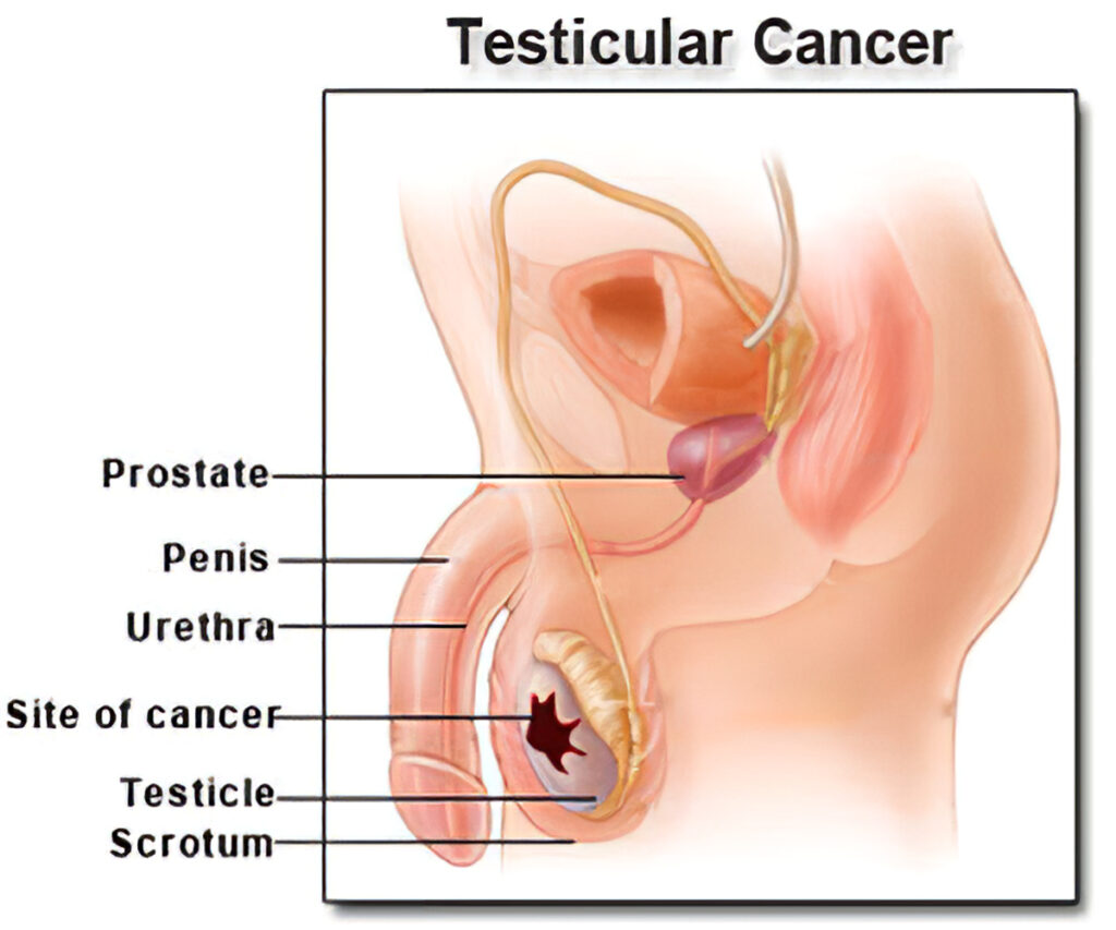 سرطان بیضه