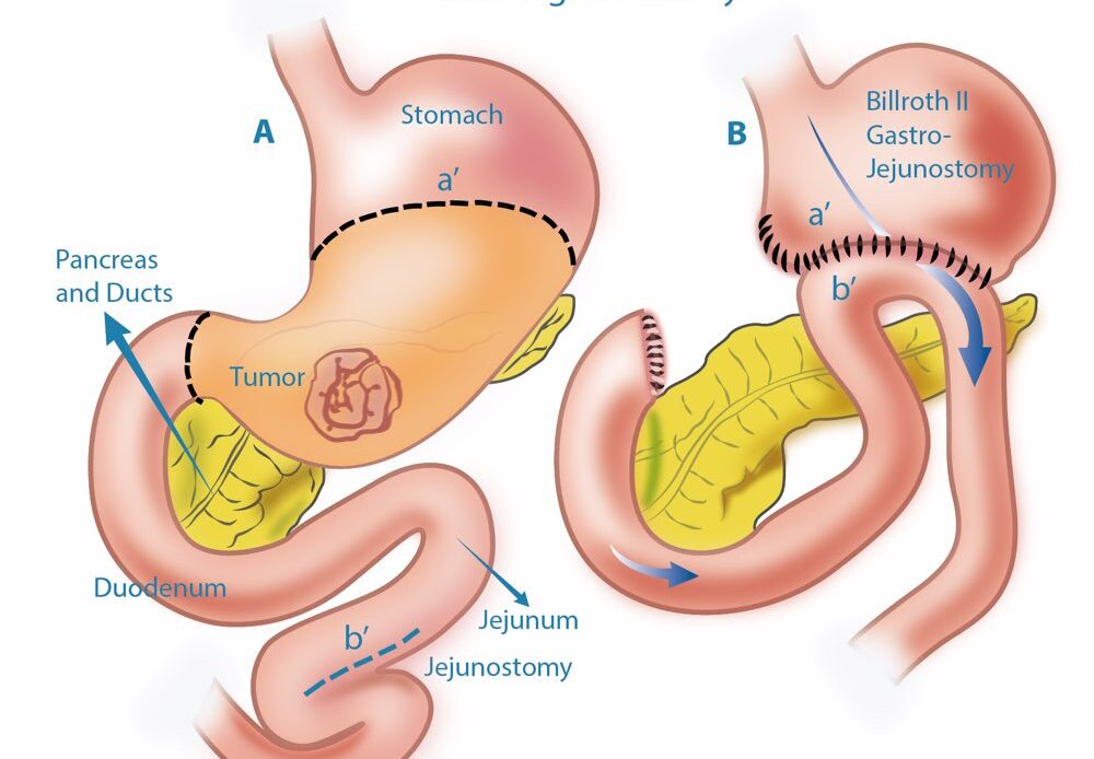 برداشتن بخشی از معده (گاسترکتومی سابتوتال)