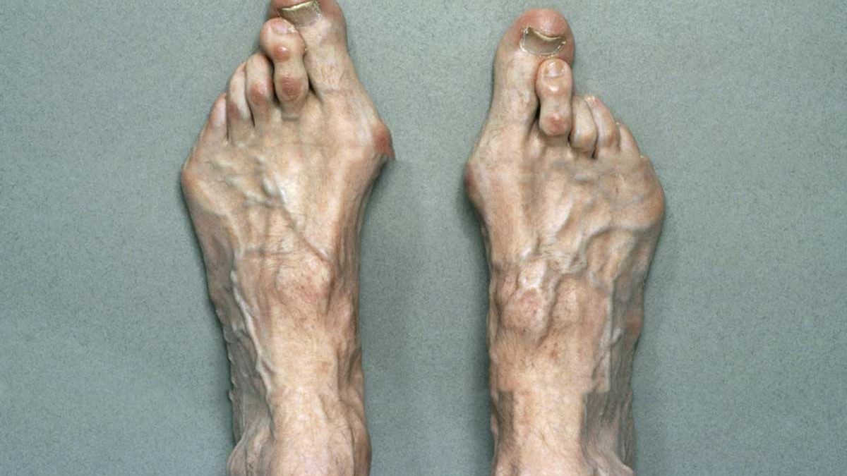 سندرم مارفان و تاثیر مخرب آن بر جوانان