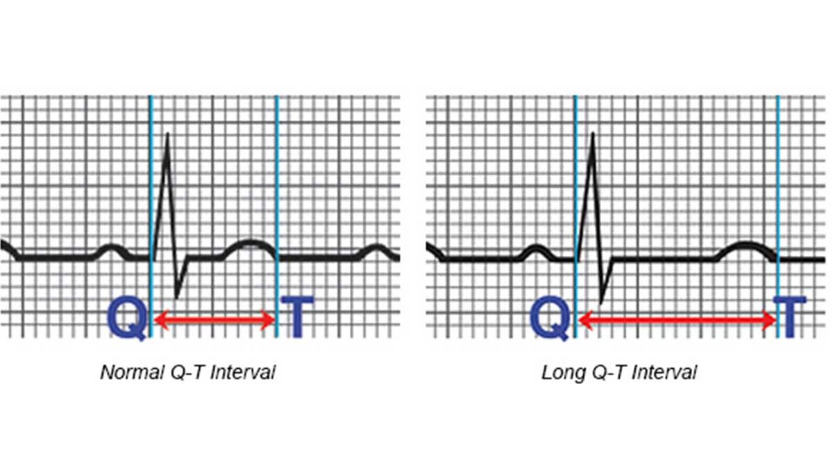 سندرم QT | انواع سندرم کیوتی | نحوه پیشگیری از سندرم Q-T