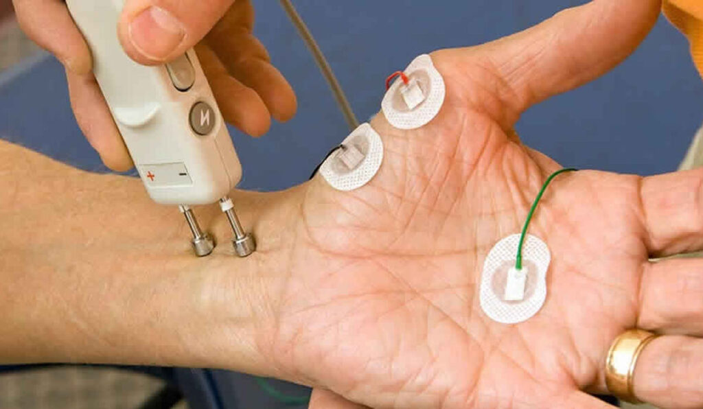 تشخیص سندروم تونل کارپال، تست هدایت عصبی، تست عصب و عضله