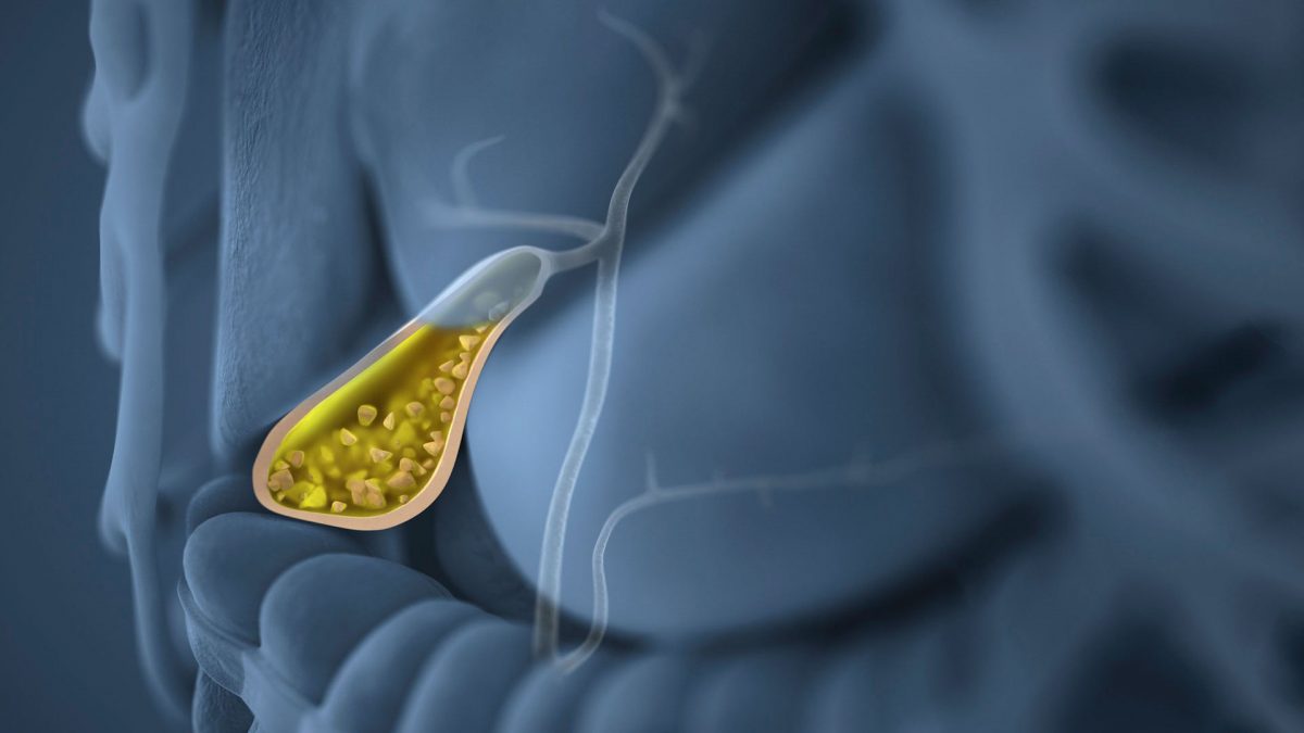 سنگ کیسه صفرا