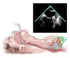 اکوکاردیوگرام ترانس ازوفاژیال