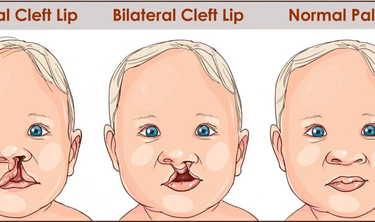 شکاف کام و لب