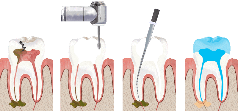 مراحل عصب کشی و ترمیم دندان به ترتیب از چپ به راست