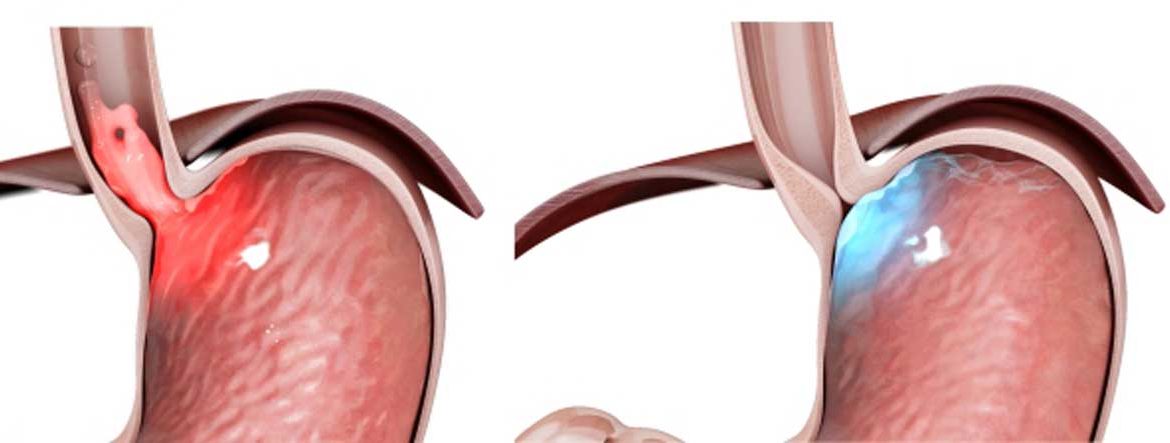 رفلاکس اسید معده