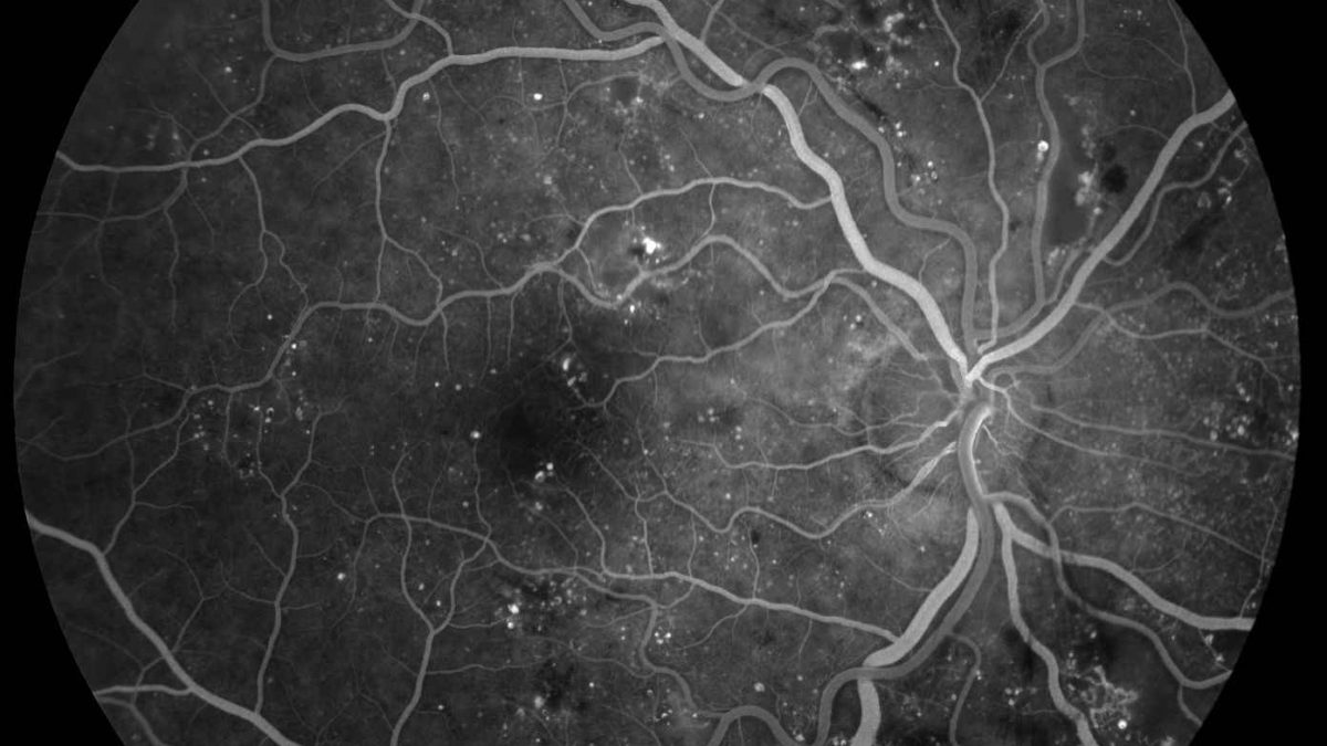 عکس آنژیوگرافی