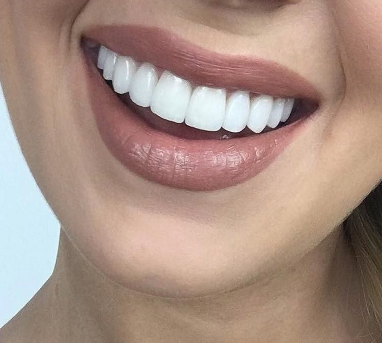 لمینت یا ونیر دندان چیست؟