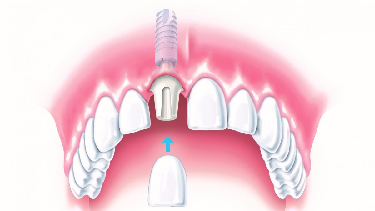 مراحل جراحی کاشت ایمپلنت دندان