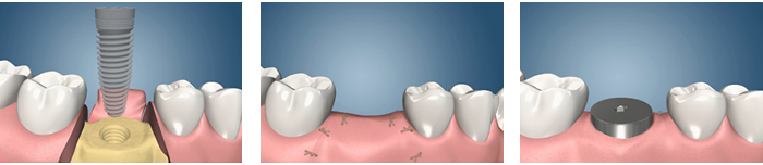 مراحل جراحی کاشت ایمپلنت دندان