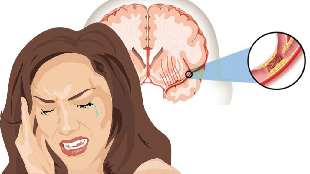 ویژگی های سکته مغزی خاموش