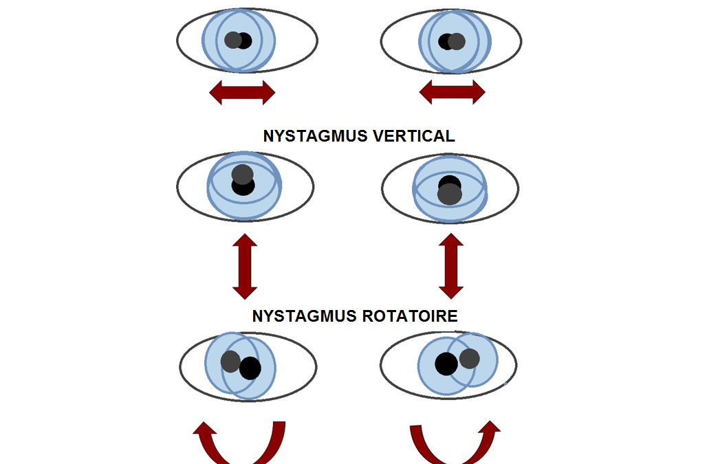 نیستاگموس یا بیماری چشم رقصان چیست ؟