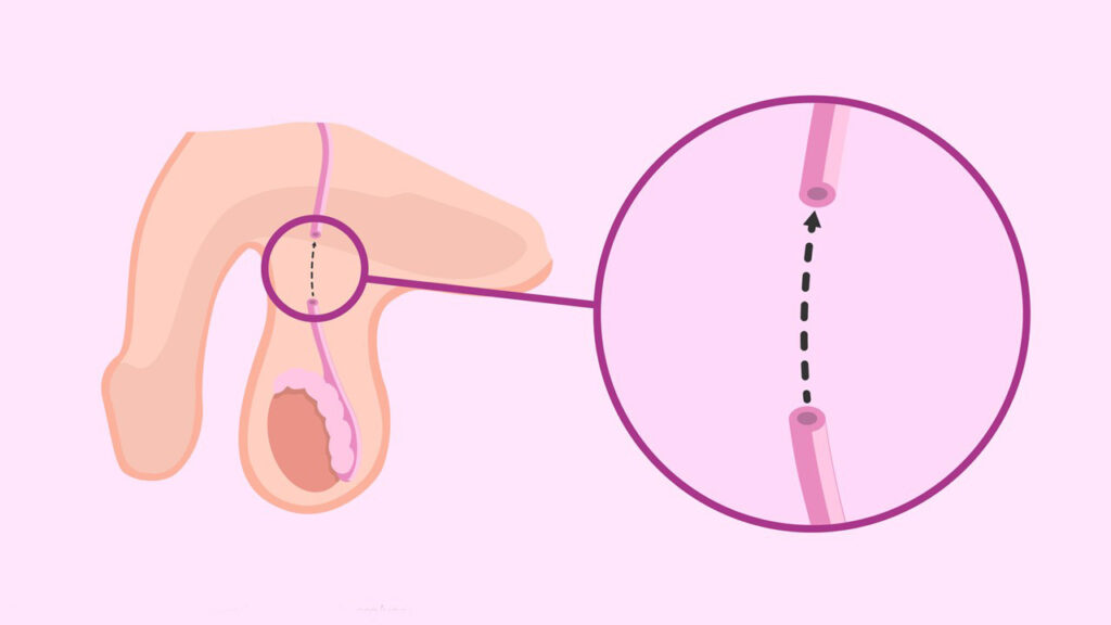 وازووازستومی بازگشت وازکتومی