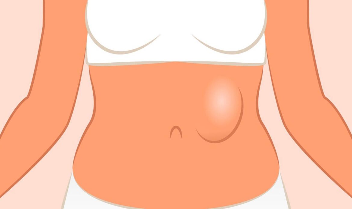 درد شکم به علت فتق