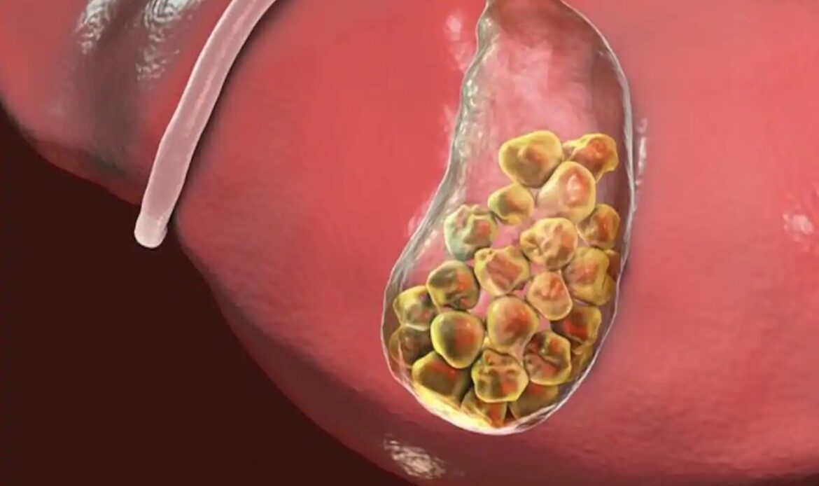 سنگ کیسه صفرا علت درد بالای شکم