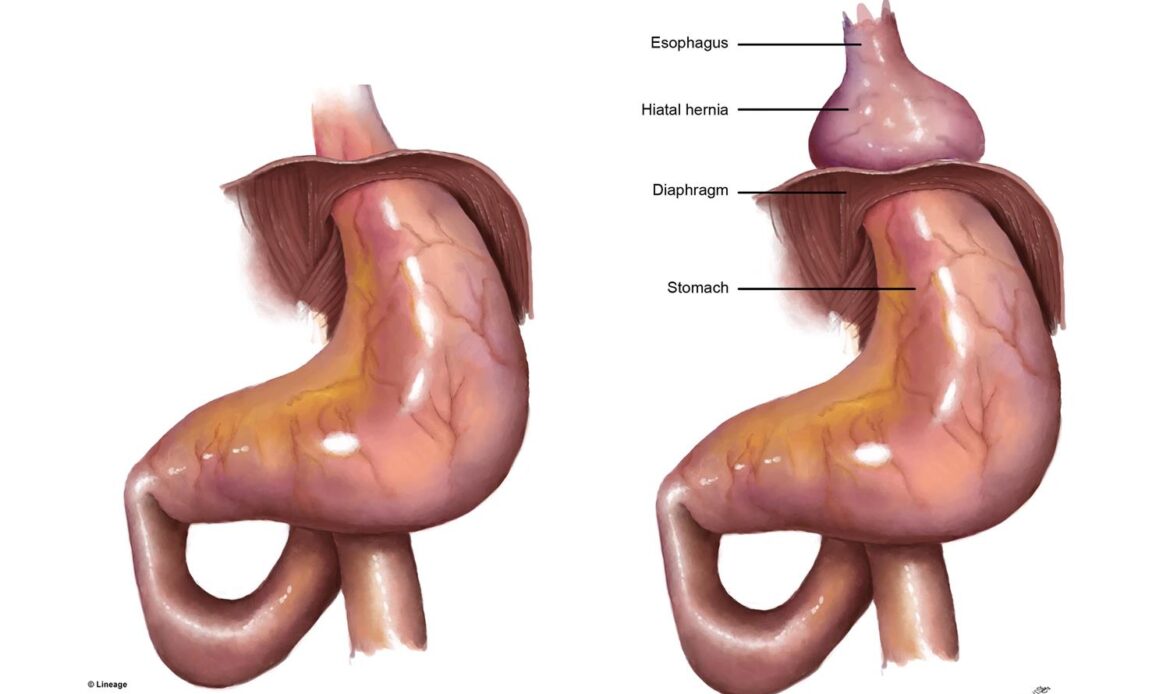 فتق هیاتال و درد بالای شکم
