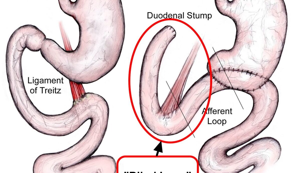 درد بالای شکم و سندروم حلقه کور(بلیند لوپ)