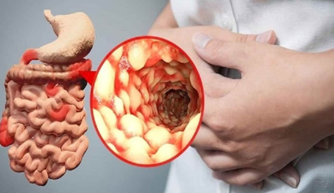 درد شکم و بیماری کرون
