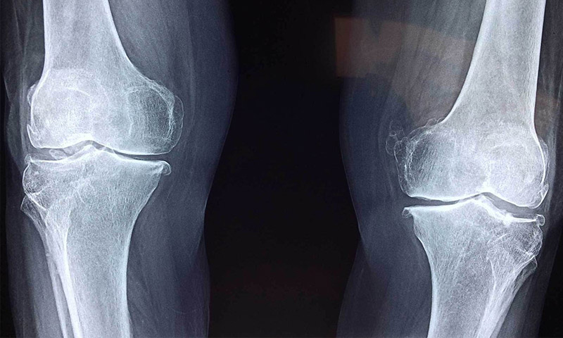 علل پارگی منیسک