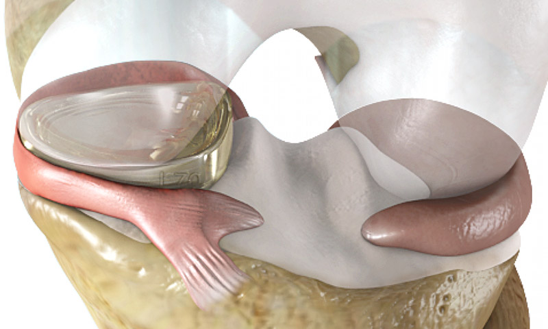 درمان پارگی منیسک زانو