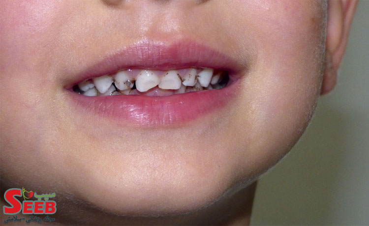 پوسیدگی-دندان-چیست