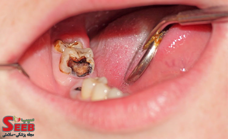 درمان-پوسیدگی-دندان-در-دندان-پزشکی
