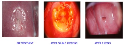 عوارض کرایوتراپی دهانه رحم