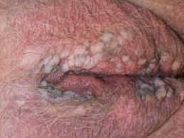 عکس زگیل تناسلی زنان