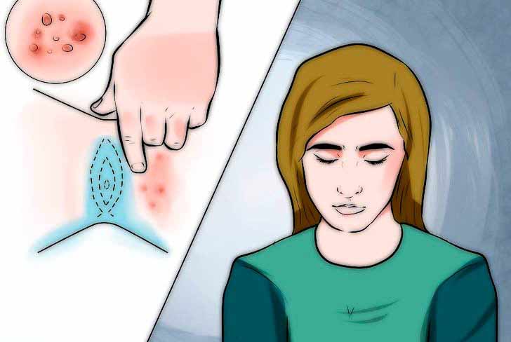 زگیل تناسلی 10