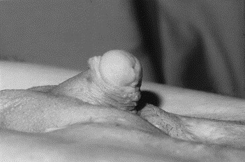 میکروفالوس