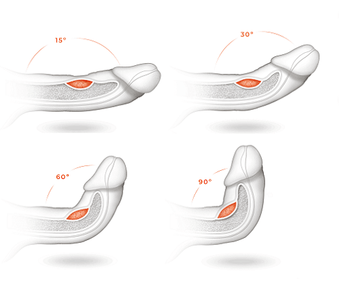 بیماری پیرونی