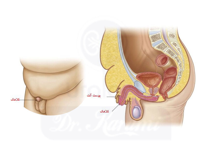 آلت تناسلی دفن شده