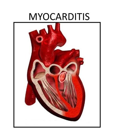 میوکاردیت 