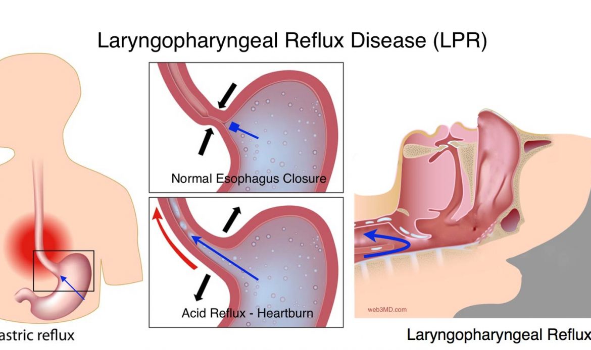 رفلاکس معده