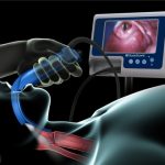 لارنگوسکوپی چیست؟ + فیلم لارنگوسکوپی حنجره لارنگوسکوپی چیست؟ + فیلم لارنگوسکوپی حنجره