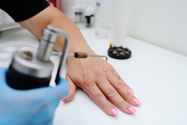 فریز کردن زگیل تناسلی
