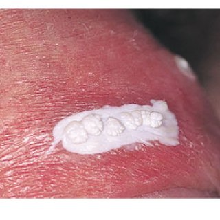 فریز کردن زگیل تناسلی