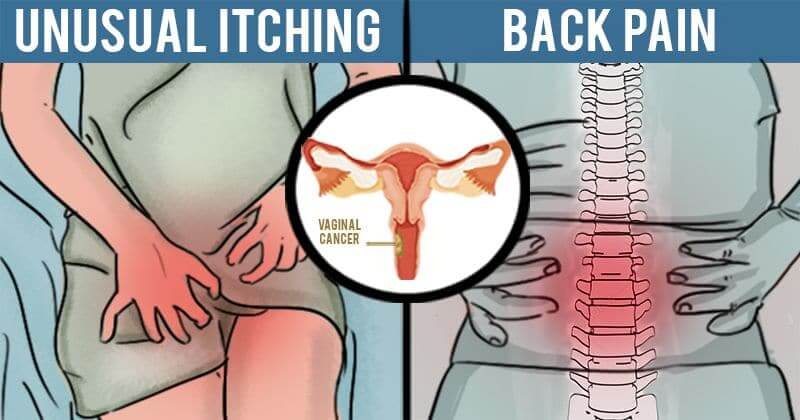 علائم سرطان واژن