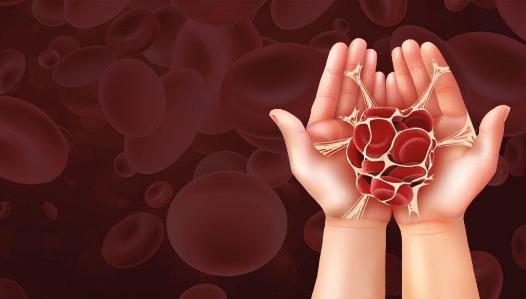 سندرم آنتی فسفولیپید (APS)