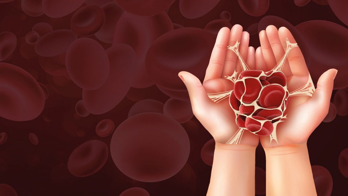 سندرم آنتی فسفولیپید (APS)