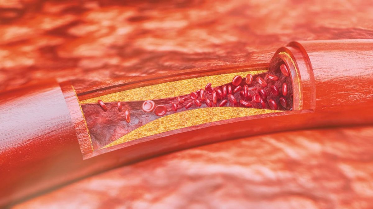 آترواسکلروز