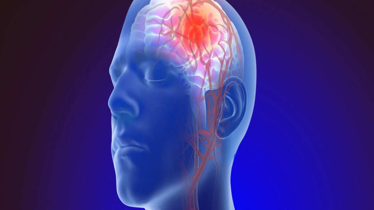 آنوریسم مغزی + روش های درمان