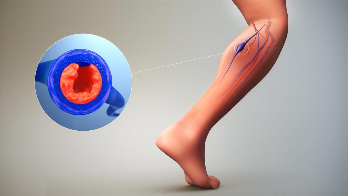 ترومبوز شریانی یا لخته خون در جریان خون