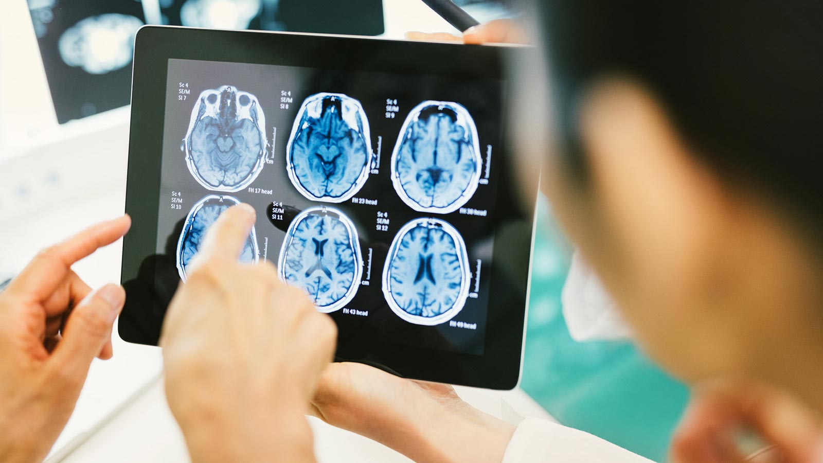 درمان آنوریسم مغزی