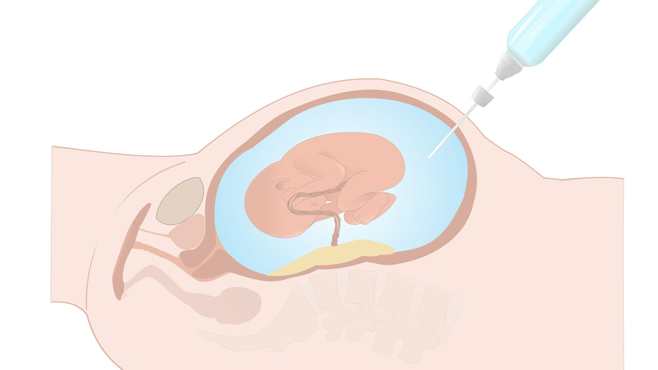 نحوه انجام آمنیوسنتز