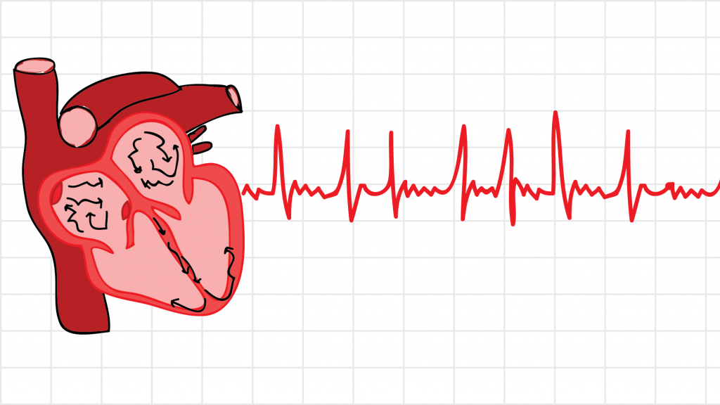 فیبریلاسیون دهلیزی