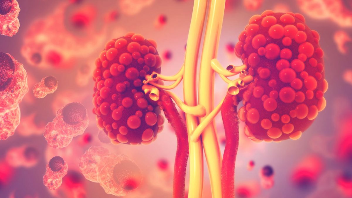 بیماری کلیه پلی کیستیک اتوزومال غالب